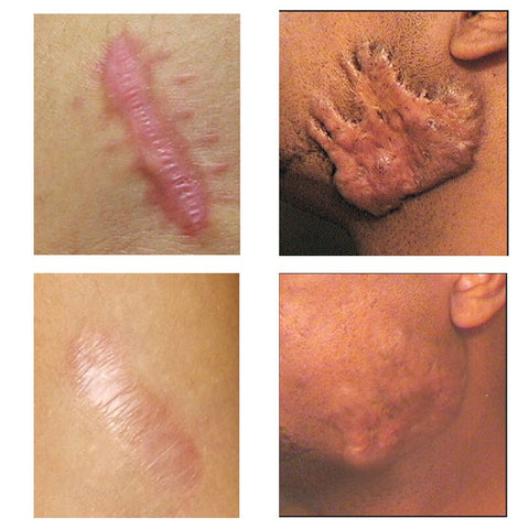LANBENA Acne Scar Removal Cream Scar Gel Skin Repair Face Cream Acne Spots Acne Treatment Skin Care Whitening Stretch Marks