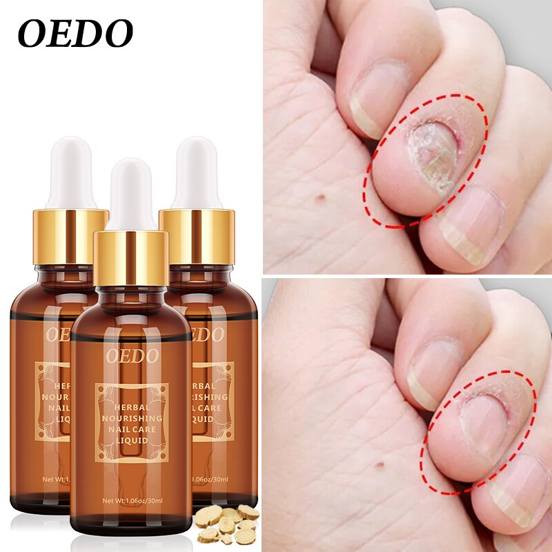 OEDO Foot Nail Fungus Removal Herbal Fungal Nail Treatment Essential oil Anti Infection Paronychia Onychomycosis Hand Care Treat