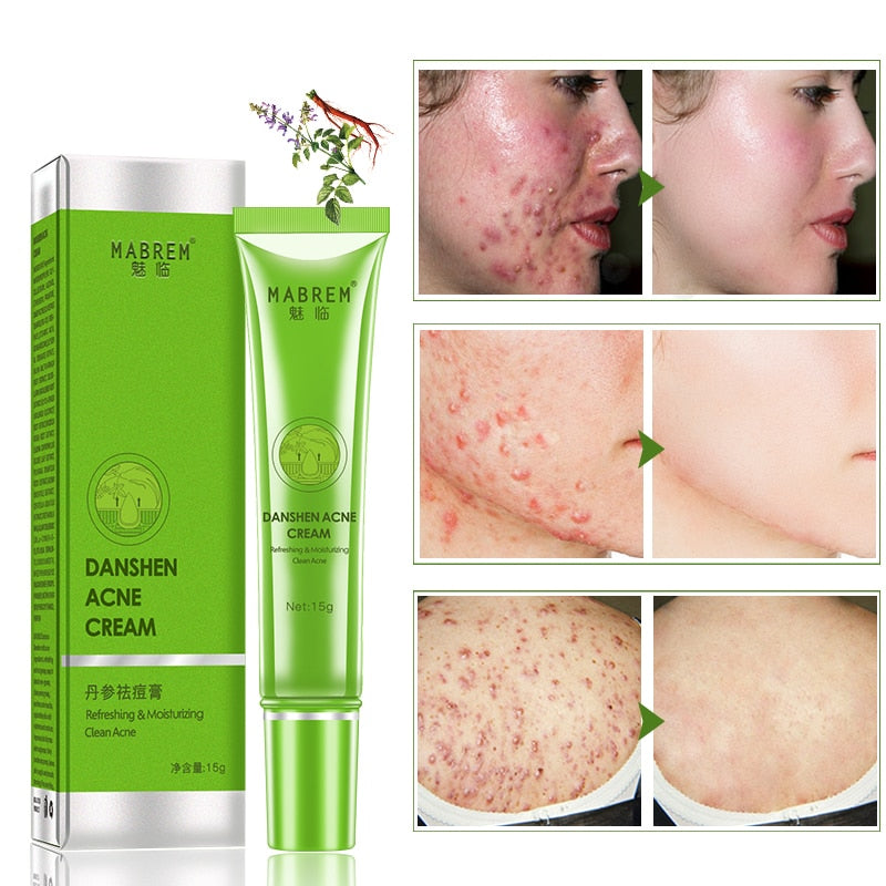 Effective Anti-Acne Cream, Acne Treatment, Fade Oil Control, Shrink Pores, Whiten Acne Moisturizing Cream, Skin Care Products