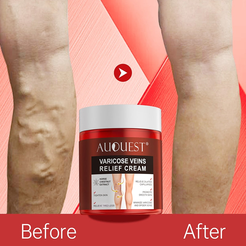 Varicose Veins Relief Cream Vasculitis Phlebitis Spider Pain Relief Ointment Medical Plaster Body Care 80g