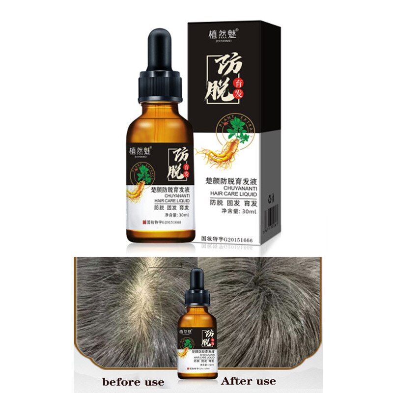 30ml hair growth essence for men and women,to prevent hair loss,prevent baldness, repair damaged hair, fast-growing hair essence
