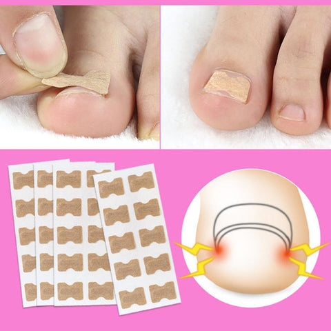 50pcs Nail Sticker Toenail Toe Ingrown Correction Patch Nail Art Glue TSLM1