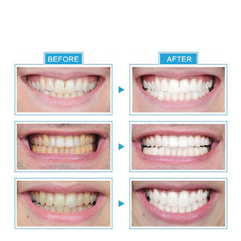 1PC LED Light Teeth Whitening Tooth Gel Whitener Health Oral Care For Personal Dental Treatment Teeth Whitening