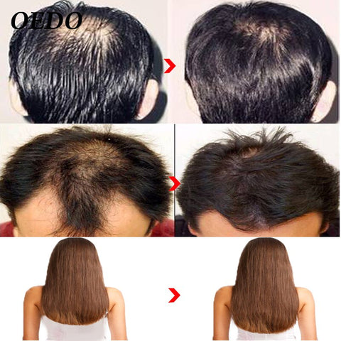 Beyprern 10Pcs Ginseng Hair Growth Essence Anti Hair Loss Liquid 20ML Fast Restoration Dense Hair Growth Serum Powerful Repair Hair Root