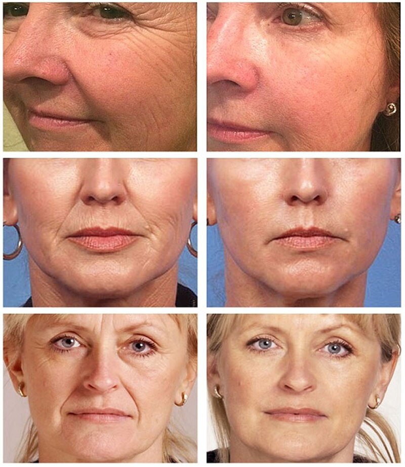 LAIKOU Blueberry Anti Wrinkles Facial Serum Brighten Skin Tone Hydrating Repair Damaged Skin Whitening Remove Spots Skin Care