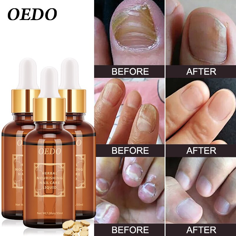 OEDO Foot Nail Fungus Removal Herbal Fungal Nail Treatment Essential oil Anti Infection Paronychia Onychomycosis Hand Care Treat
