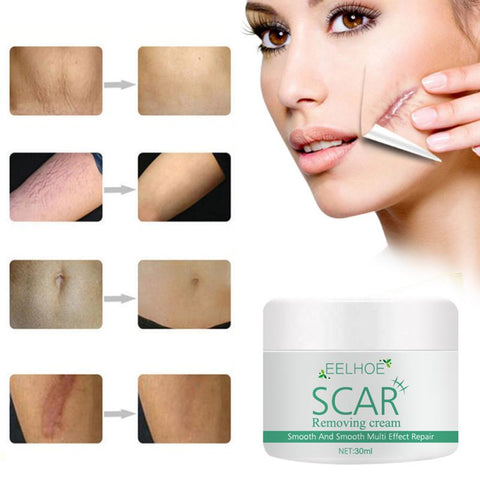 Smooth Skin Acne Scar Stretch Mark Remover Repair Cream Acne Spot Scar Cream Scar Removal Women Effective Face Care Product