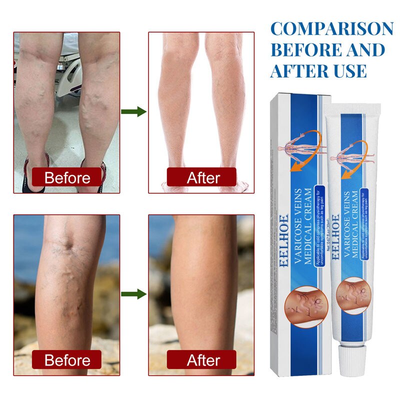 Beyprern Varicose Veins Treatment Cream Relieve Tired Legs Dilated Vasculitis Phlebitis Spider Pain Relief Ointment Body Care 20G