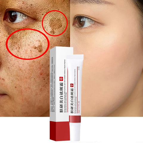 Beyprern Effective Whitening Freckle Cream Remove Dark Spots Melasma Melanin Fade Acne Scars Pigmentation Anti-Aging Brighten Skin Care