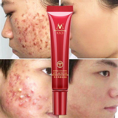 Effective Acne Removal Cream Herbal Anti-acne Repair Fade Acne Spots Oil Control Whitening Moisturizing Face Gel Skin Care 15g